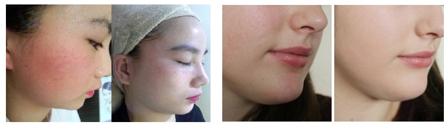 máy trị giãn mao mạch máu