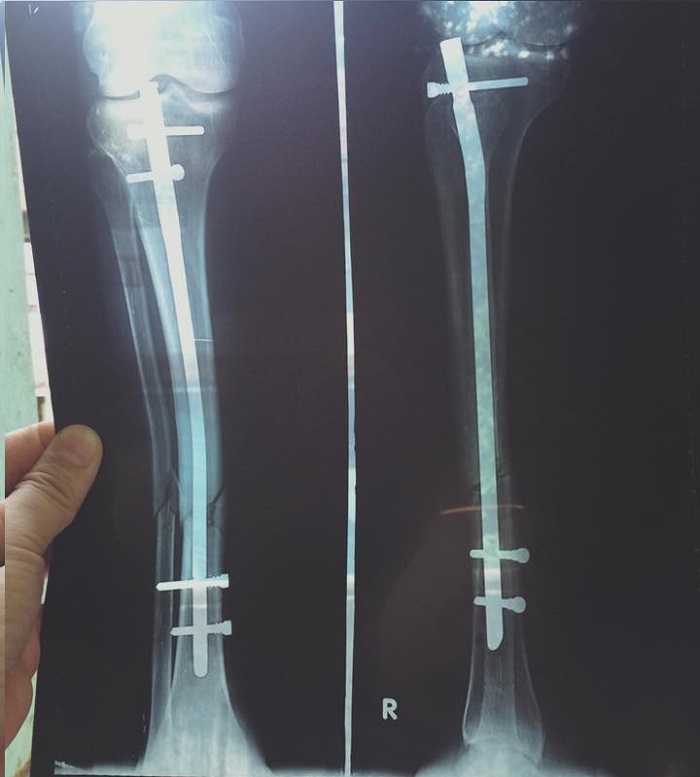 đinh nội tủy xương chày có chốt khóa