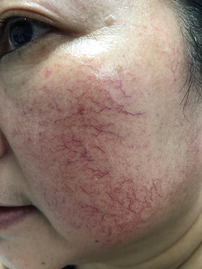 máy laser trị giãn mao mạch -11