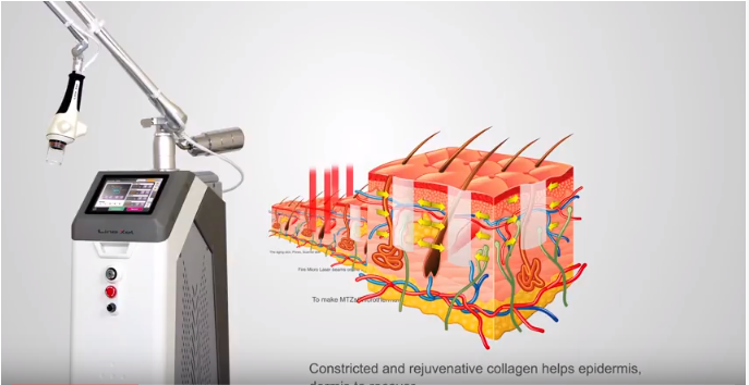 may tri seo fractional co2 laser