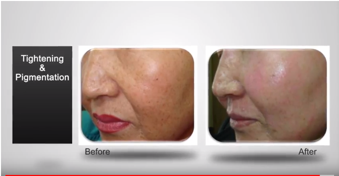 máy trị sẹo