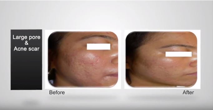 máy trị rạn da