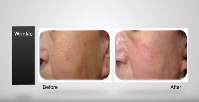 máy trị sẹo, trị rạn da