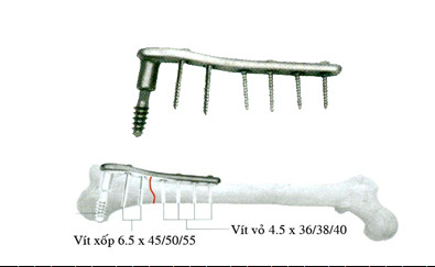 nẹp vít xương dcs