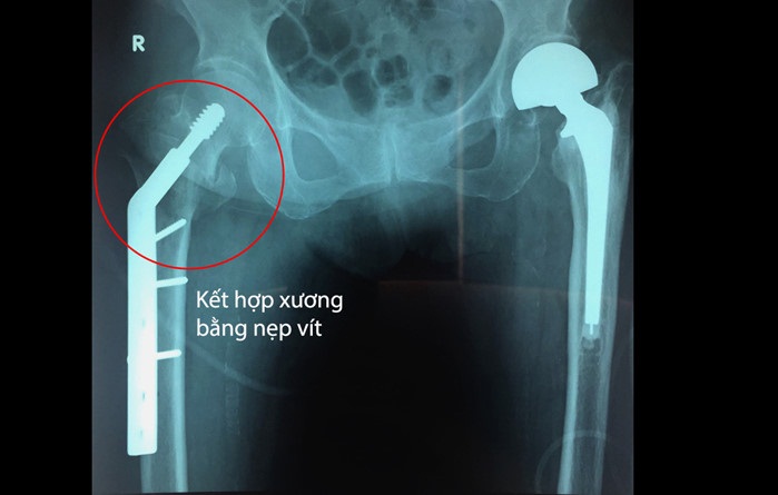 nẹp vít xương dcs
