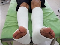 Điều trị bảo tồn gãy xương cẳng chân bằng phương pháp bó bột thủy tinh